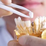 Are Dental Implants Still Worth It in 2026? What’s Changed and Why More People Choose Them