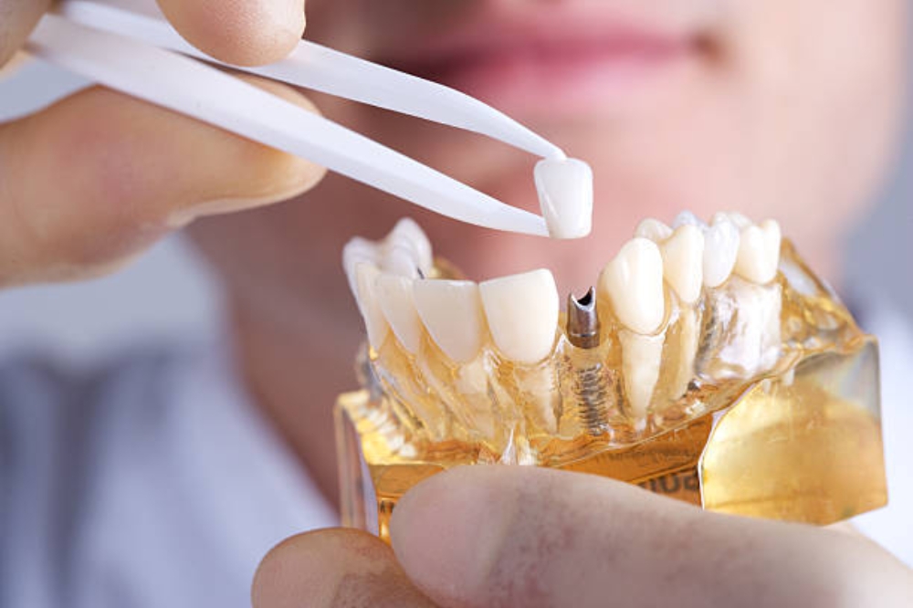 Are Dental Implants Still Worth It in 2026? What’s Changed and Why More People Choose Them