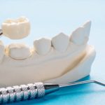 Signs You Might Need a Dental Crown Before It’s Too Late