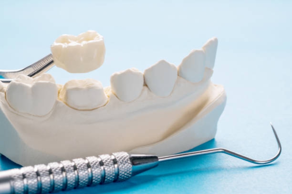 Signs You Might Need a Dental Crown Before It’s Too Late