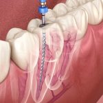 Is Root Canal Therapy Safe? Modern Dentistry Explained