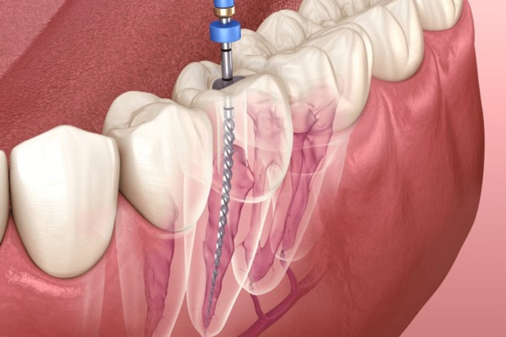 Is Root Canal Therapy Safe? Modern Dentistry Explained